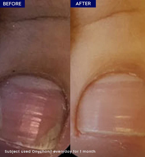 Onychonil Nail Paint - Image 3